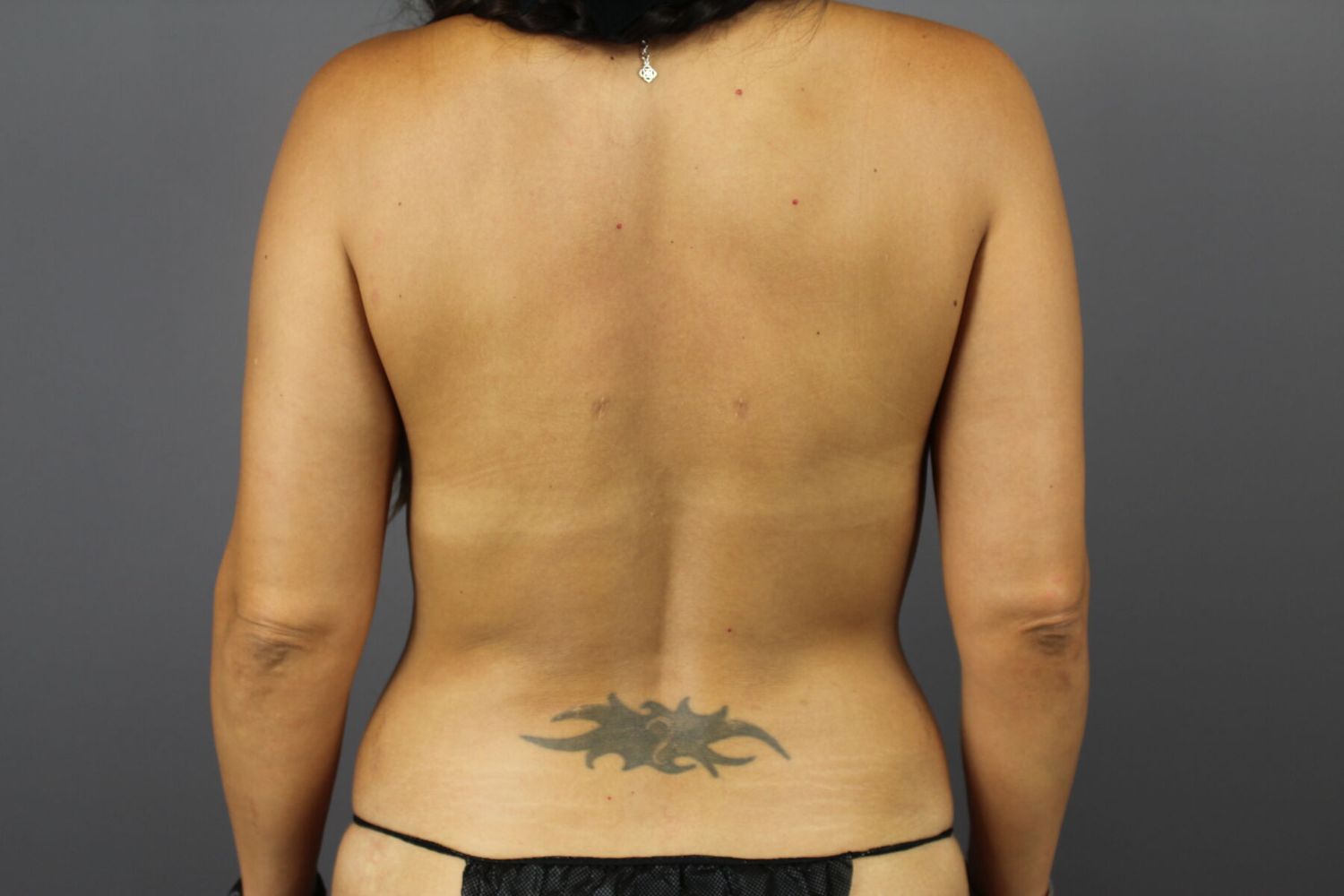 Brazilian Butt Lift Before & After
