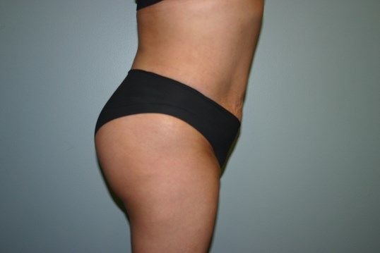 Brazilian Butt Lift Before & After
