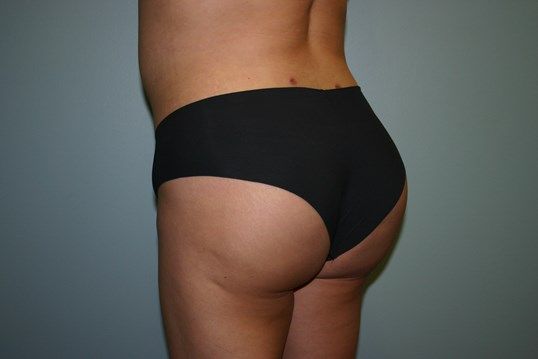 Brazilian Butt Lift Before & After