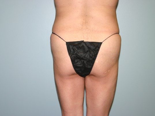 Brazilian Butt Lift Before & After