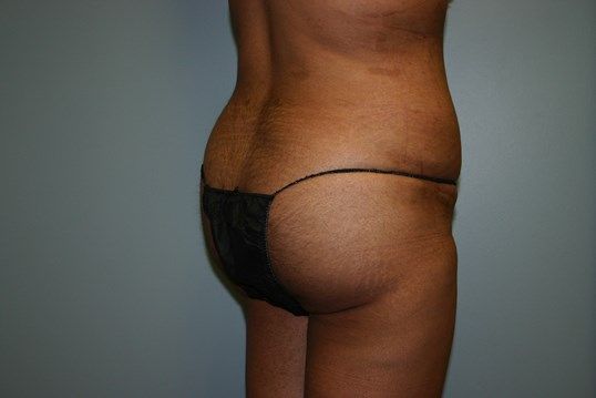 Brazilian Butt Lift Before & After