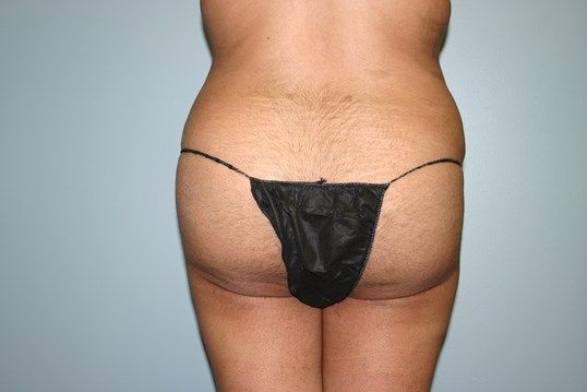 Brazilian Butt Lift Before & After