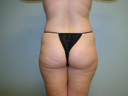 Brazilian Butt Lift Before & After