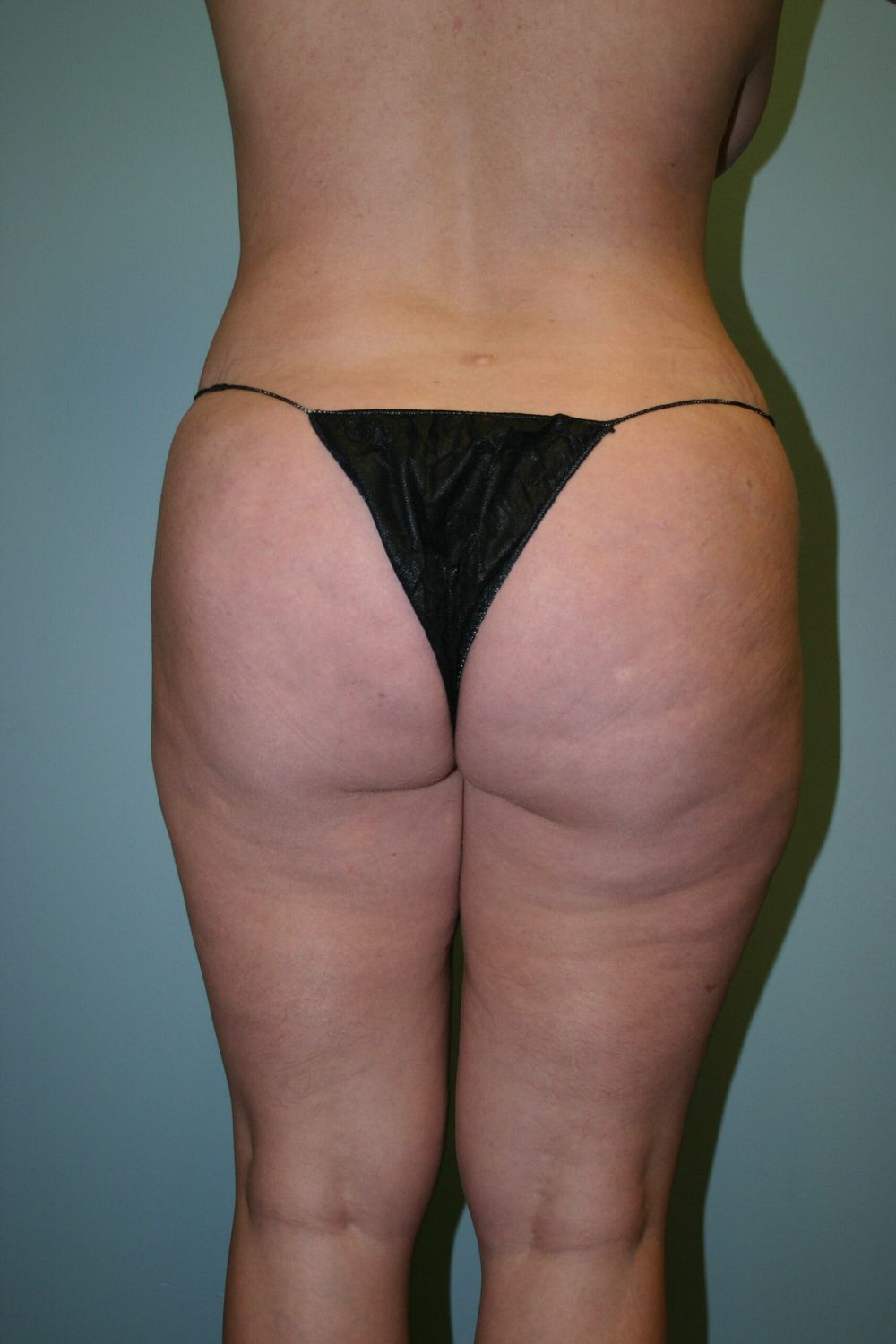 Brazilian Butt Lift Before & After
