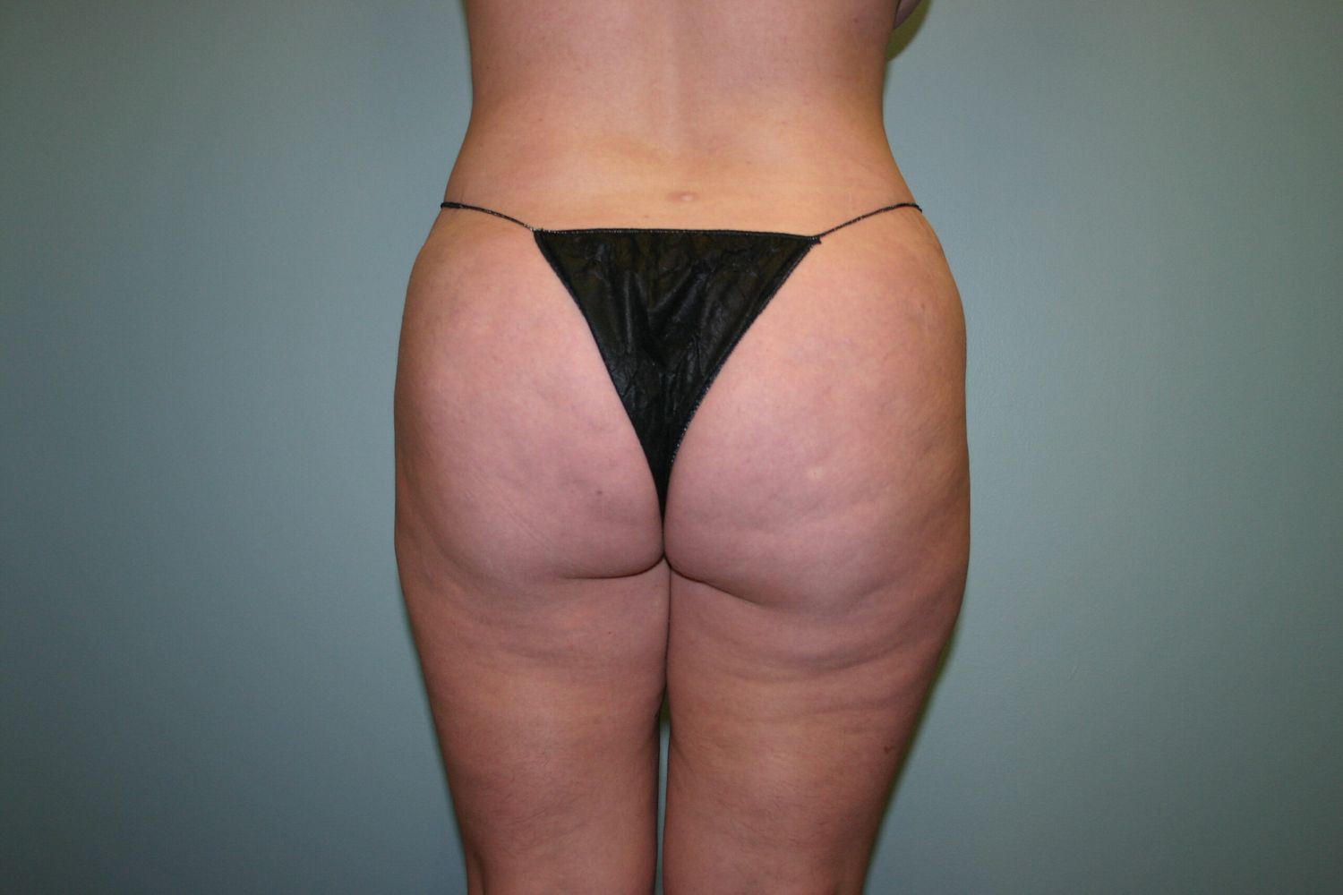 Brazilian Butt Lift Before & After