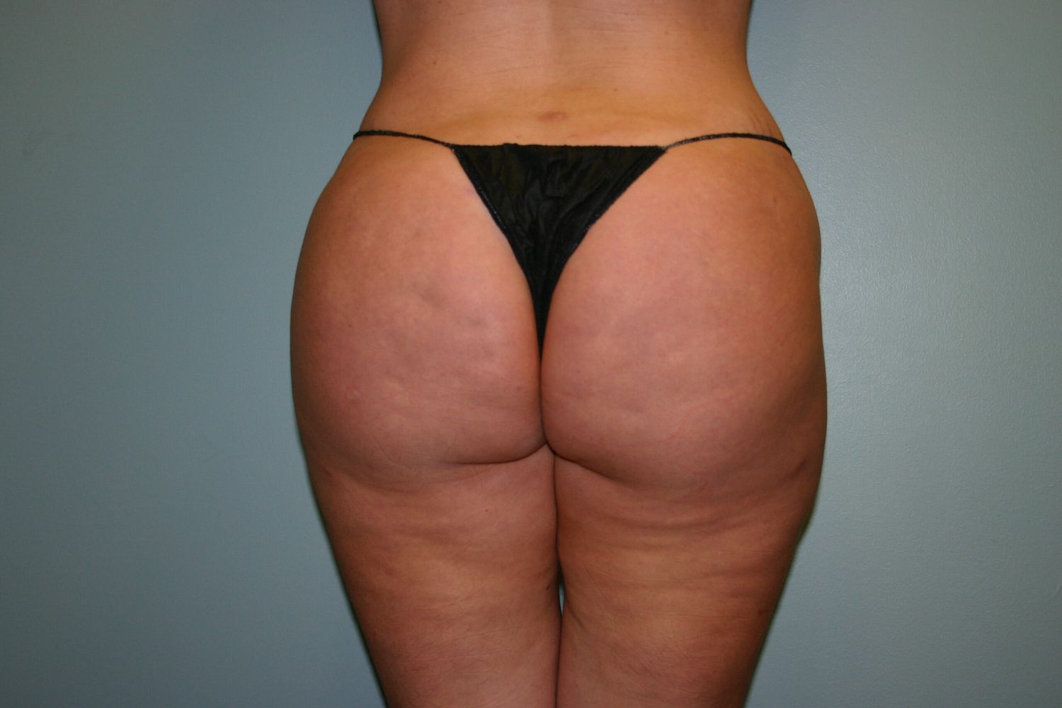 Brazilian Butt Lift Before & After
