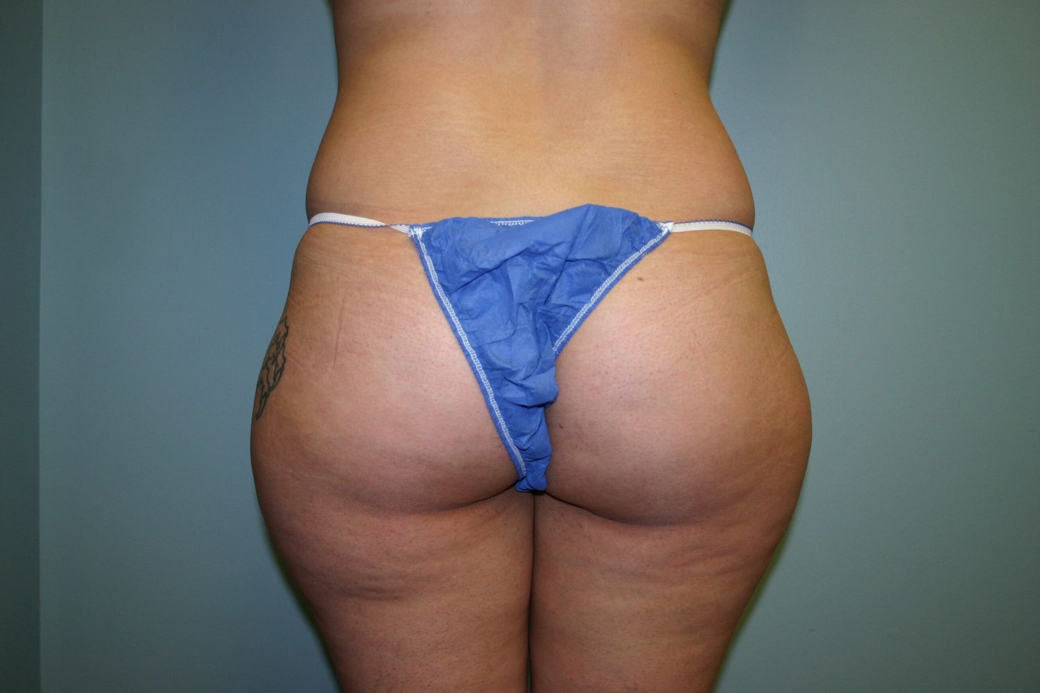 Brazilian Butt Lift Before & After