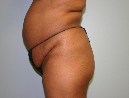 Brazilian Butt Lift Before & After