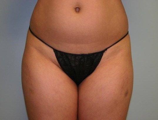 Brazilian Butt Lift Before & After
