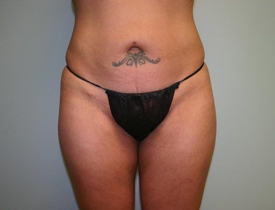 Brazilian Butt Lift Before & After