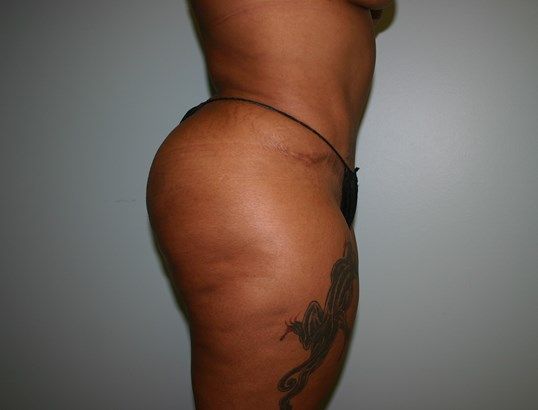 Brazilian Butt Lift Before & After