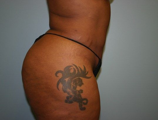 Brazilian Butt Lift Before & After