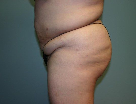 Brazilian Butt Lift Before & After