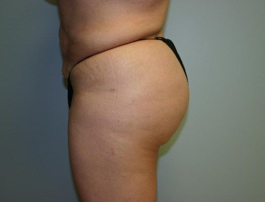Brazilian Butt Lift Before & After