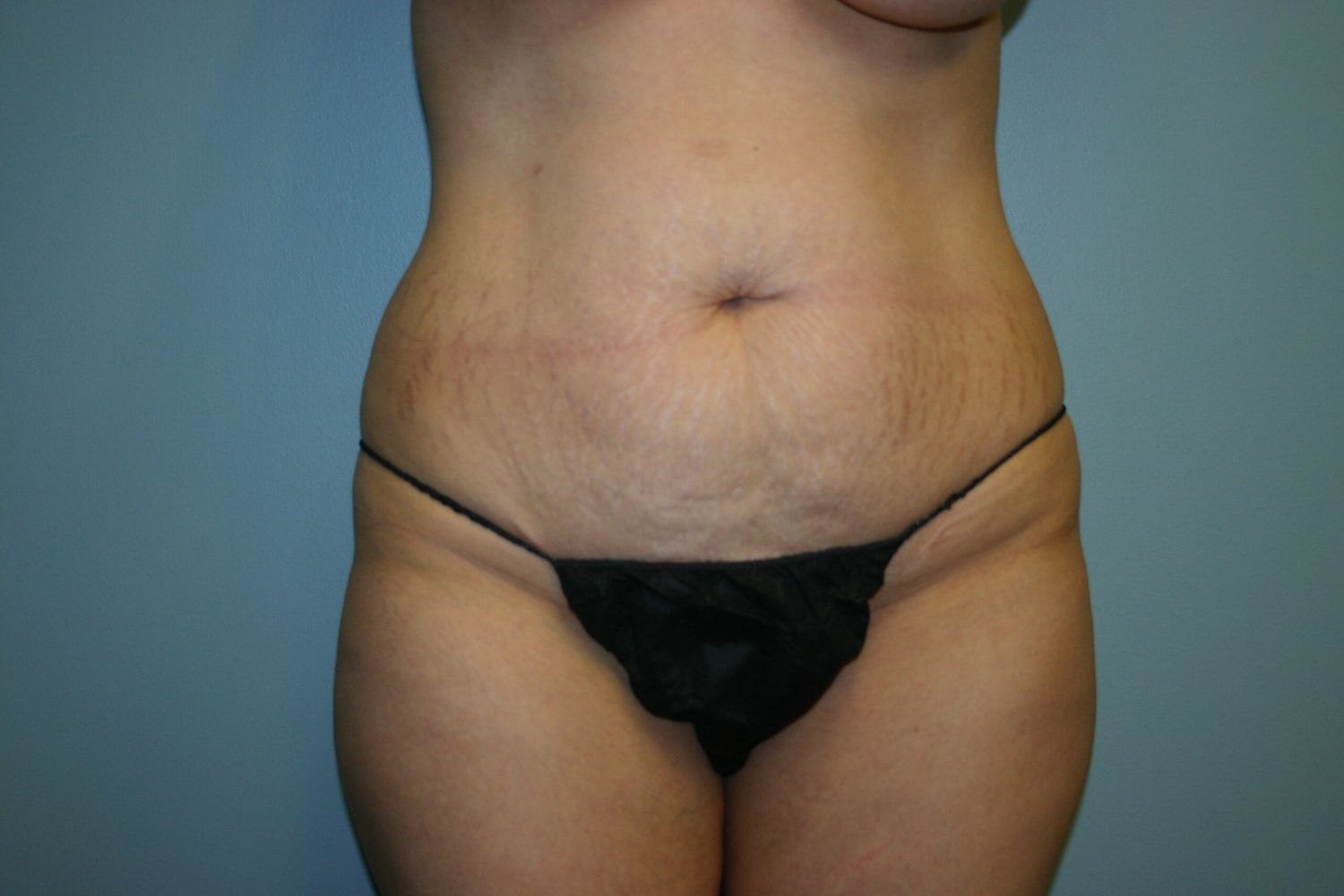Liposuction Before & After