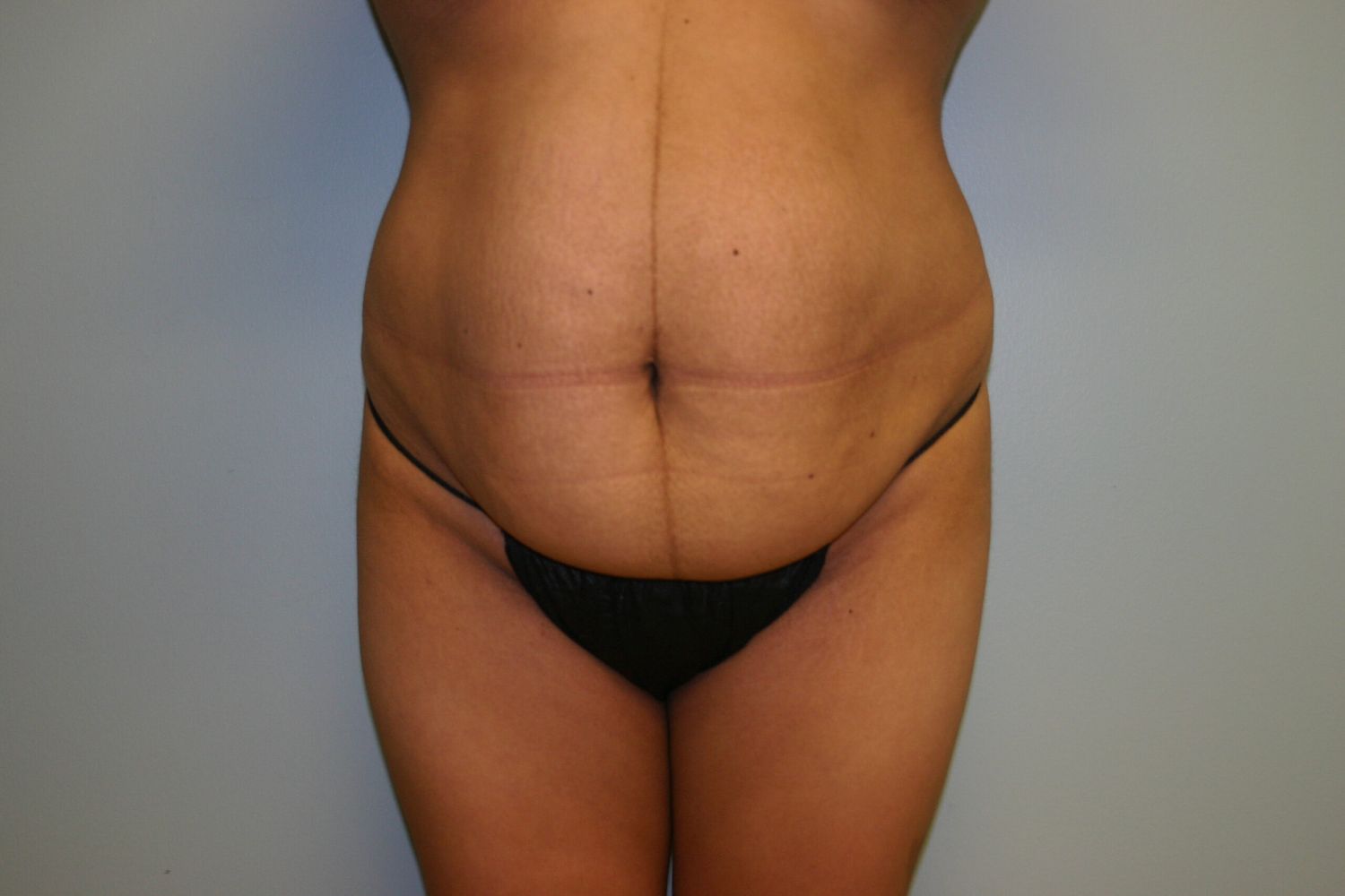 Liposuction Before & After