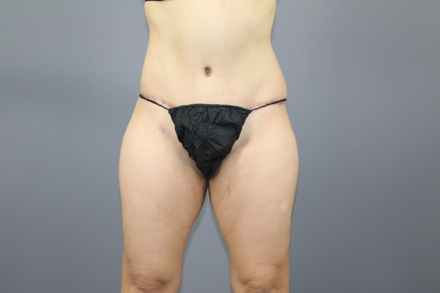 Liposuction Before & After