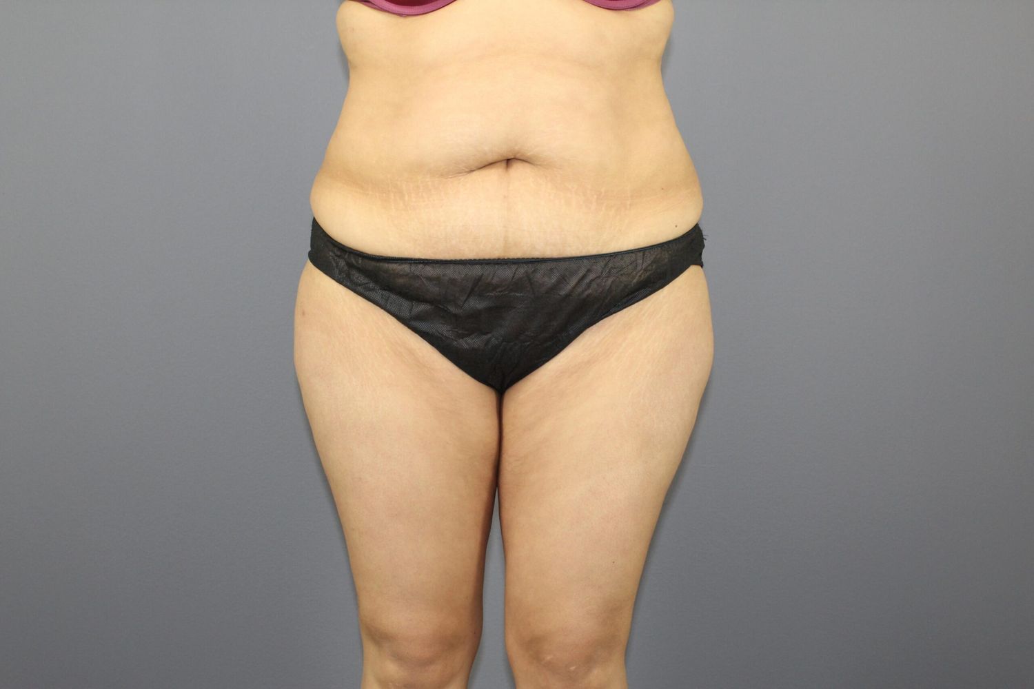 Liposuction Before & After