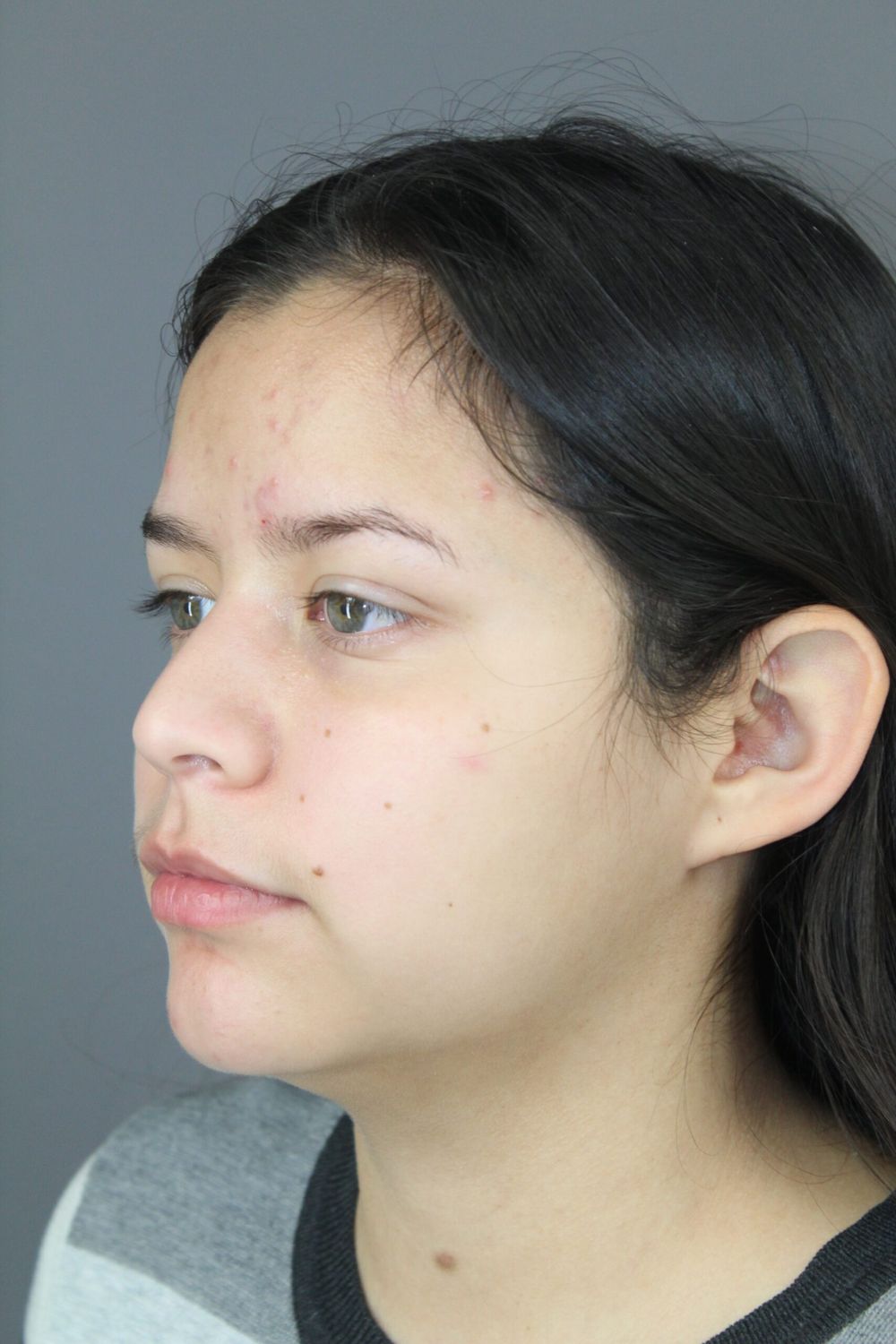 Liposuction Before & After