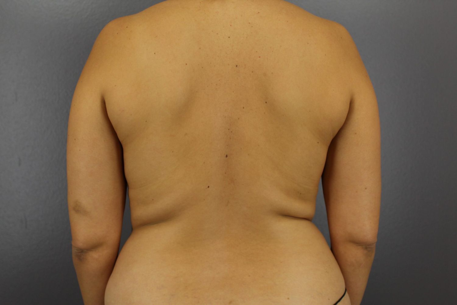 Liposuction Before & After