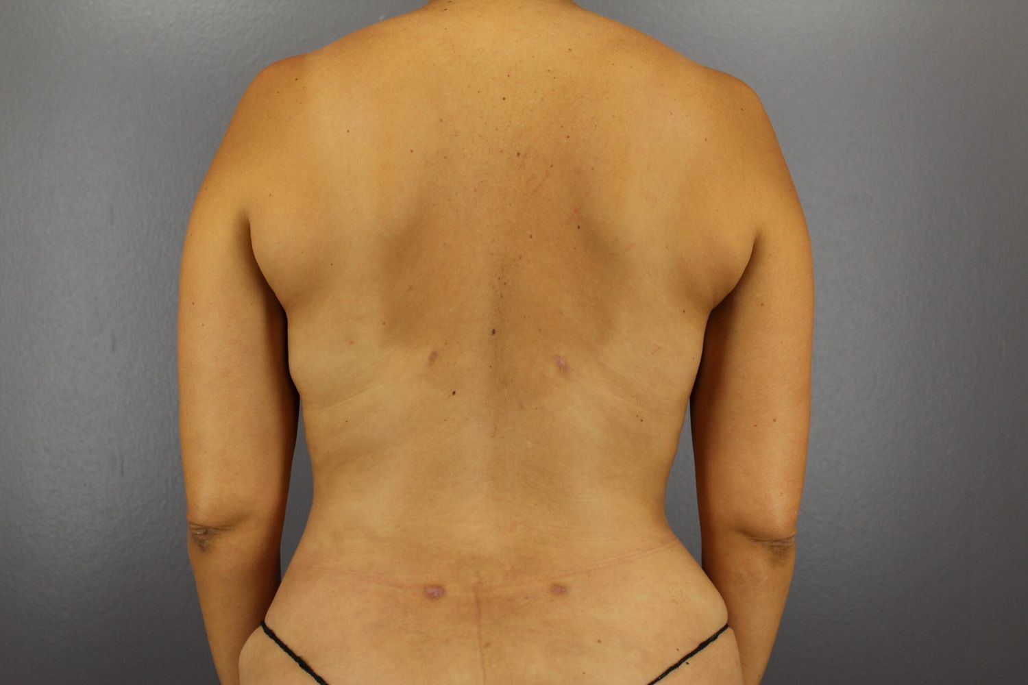 Liposuction Before & After