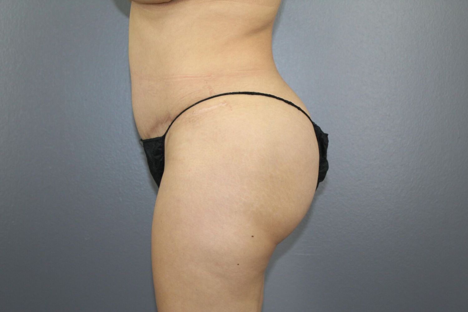 Liposuction Before & After