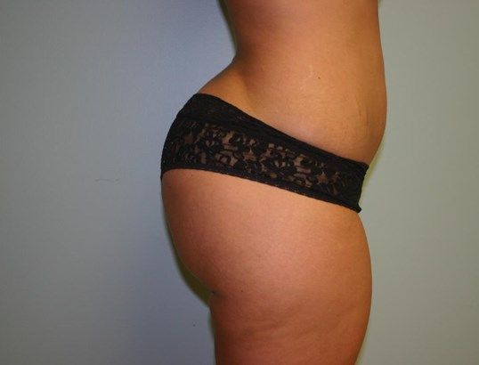 Liposuction Before & After