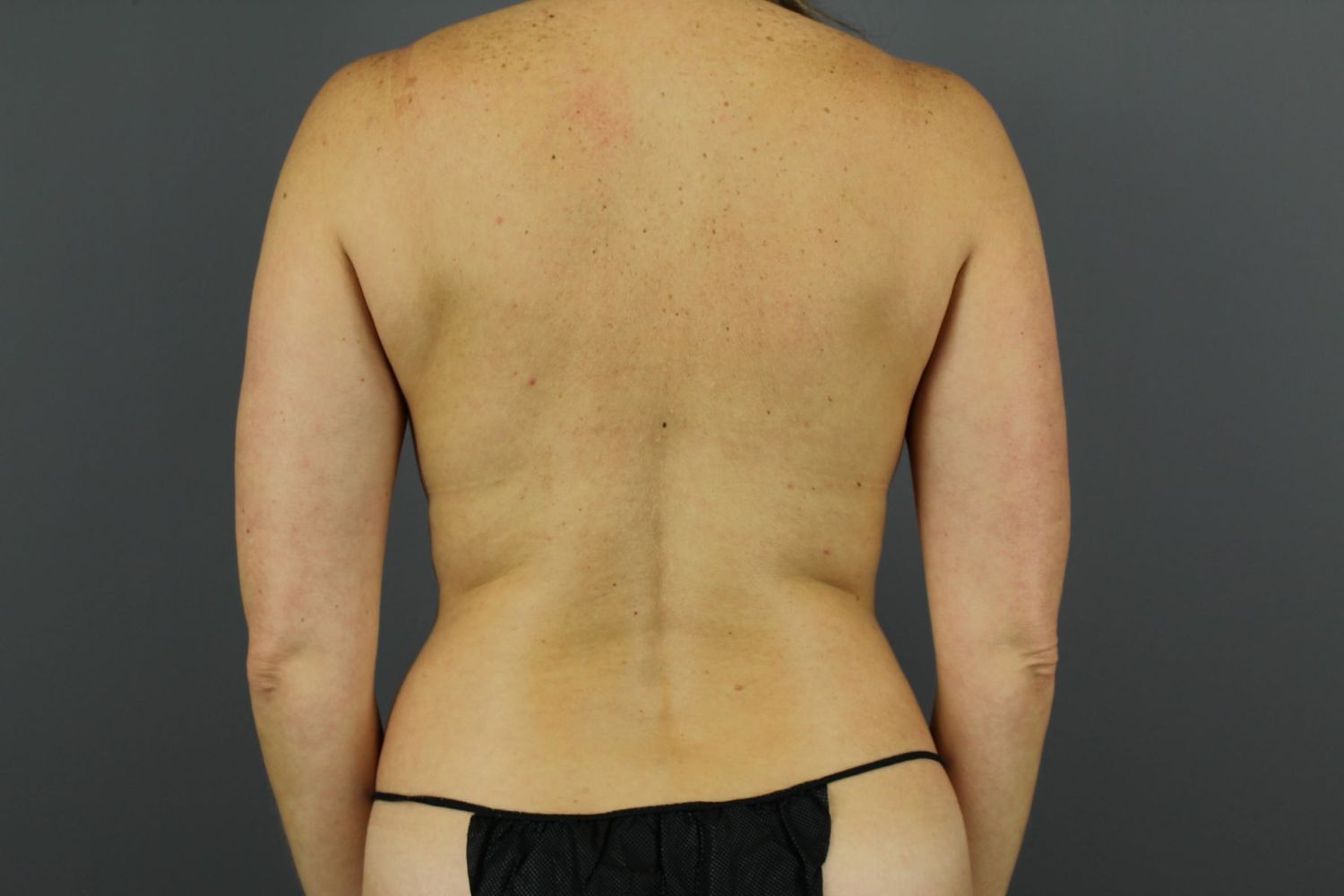 Liposuction Before & After