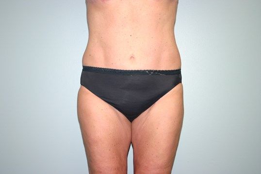 Liposuction Before & After