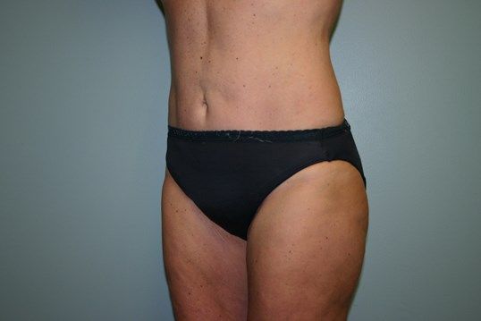 Liposuction Before & After