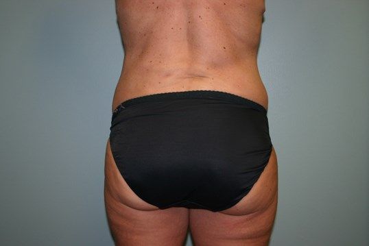 Liposuction Before & After