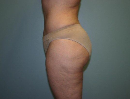 Liposuction Before & After