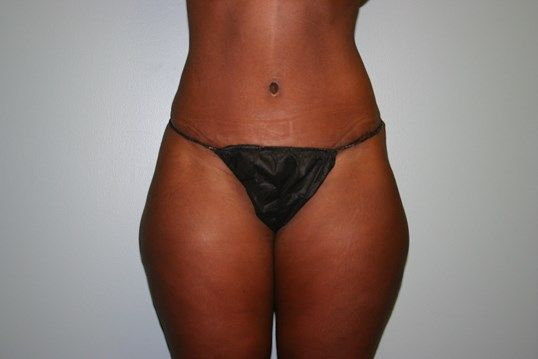 Liposuction Before & After