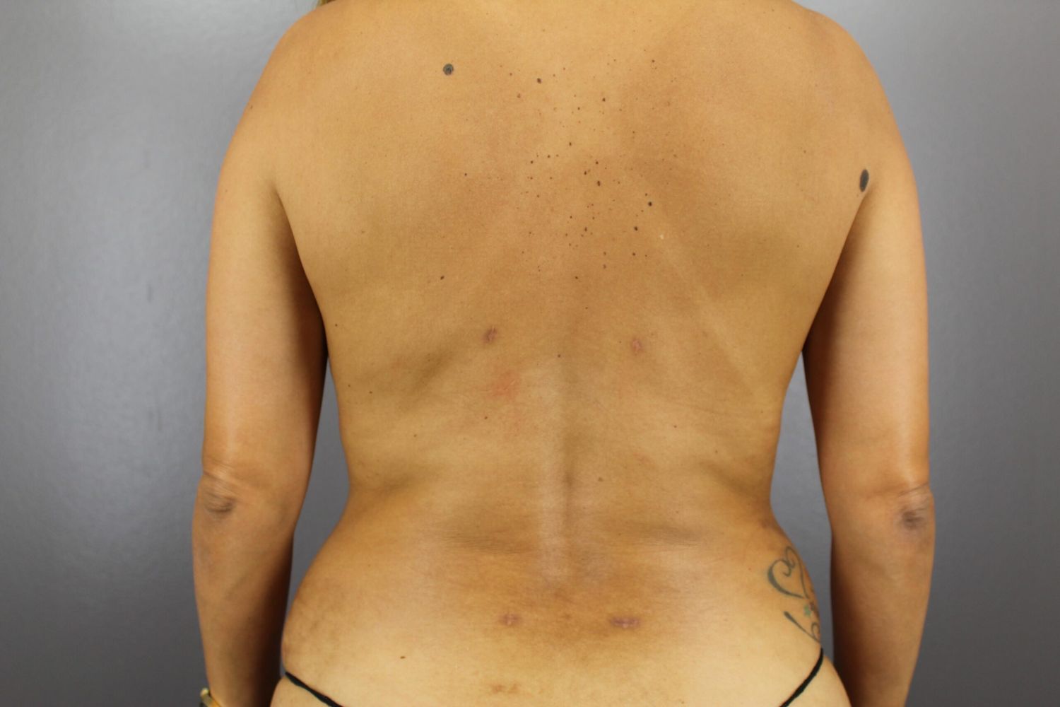 Liposuction Before & After