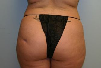 Liposuction Before & After