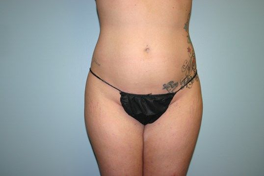 Liposuction Before & After