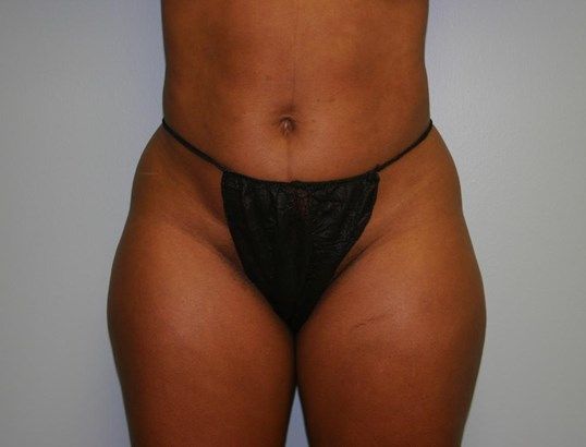 Liposuction Before & After
