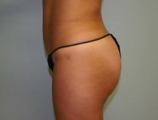 Liposuction Before & After