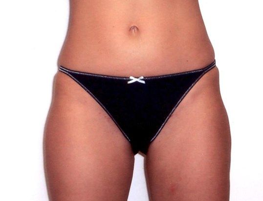 Liposuction Before & After