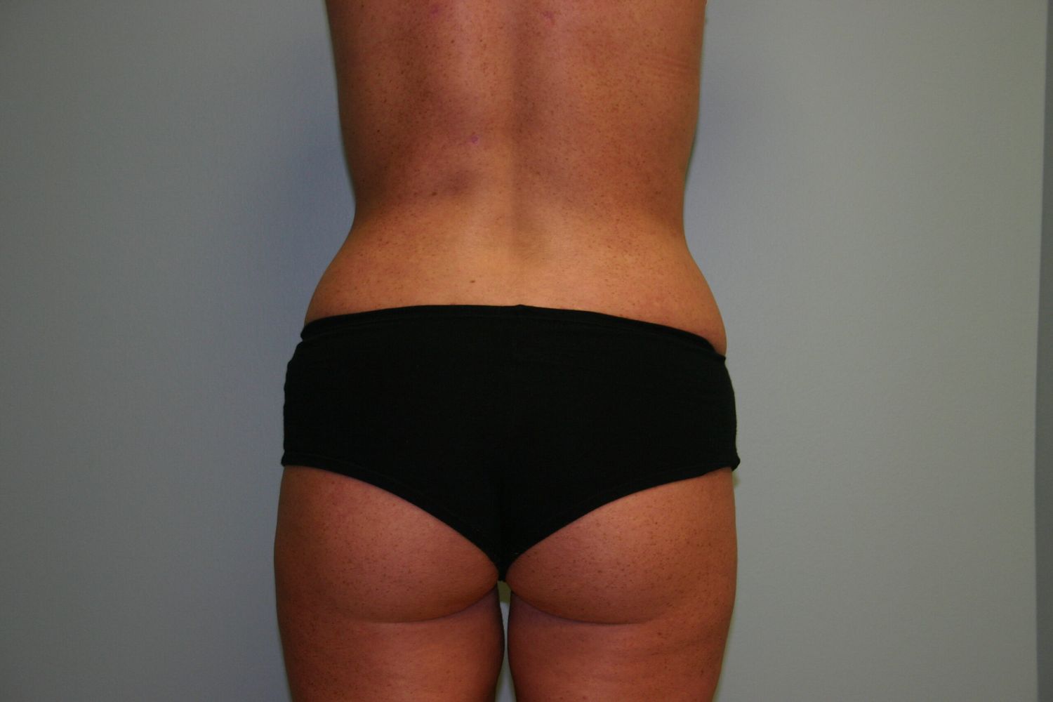 Liposuction Before & After