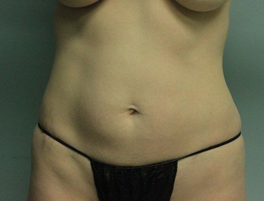 Liposuction Before & After