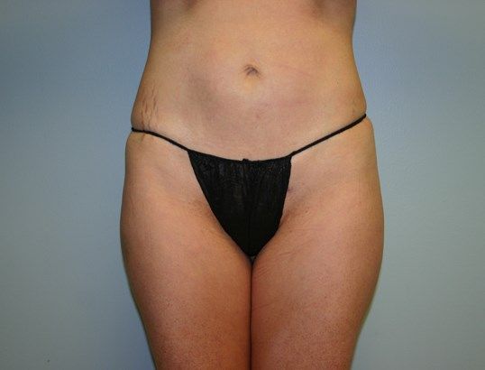 Liposuction Before & After