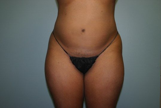Liposuction Before & After