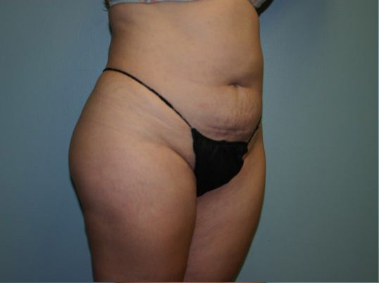 Liposuction Before & After
