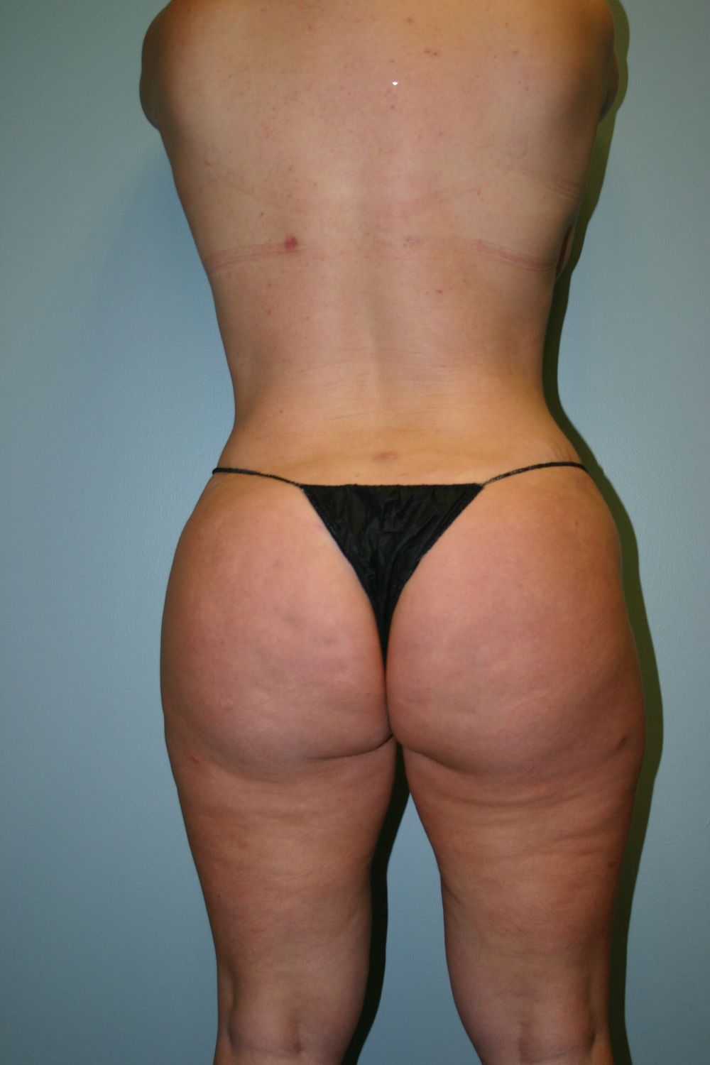 Liposuction Before & After