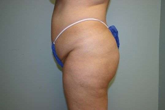 Liposuction Before & After