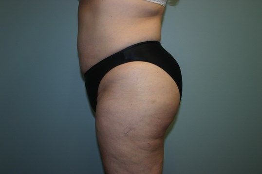 Liposuction Before & After