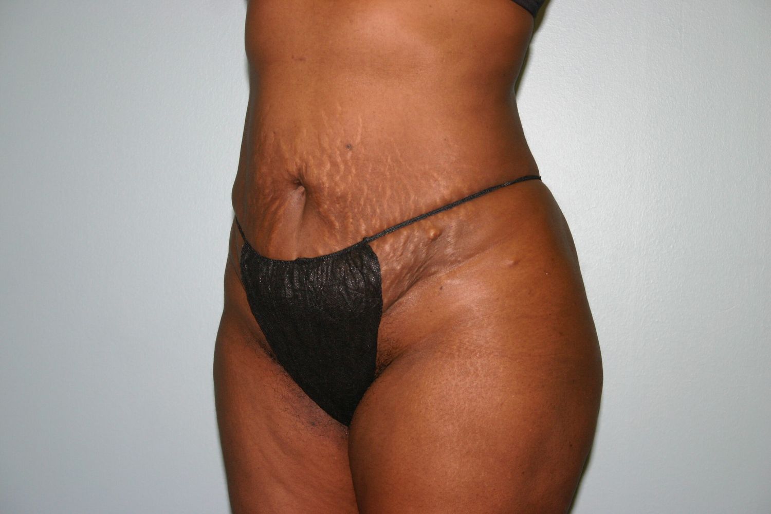 Liposuction Before & After