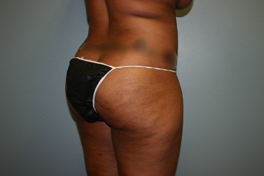 Liposuction Before & After