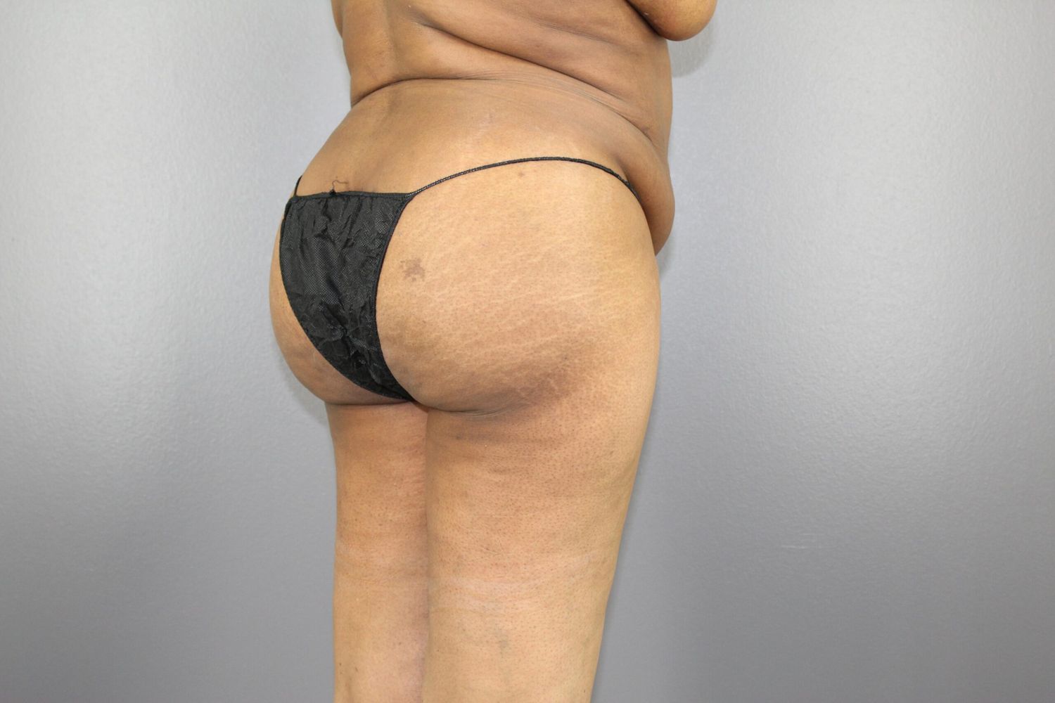 Liposuction Before & After